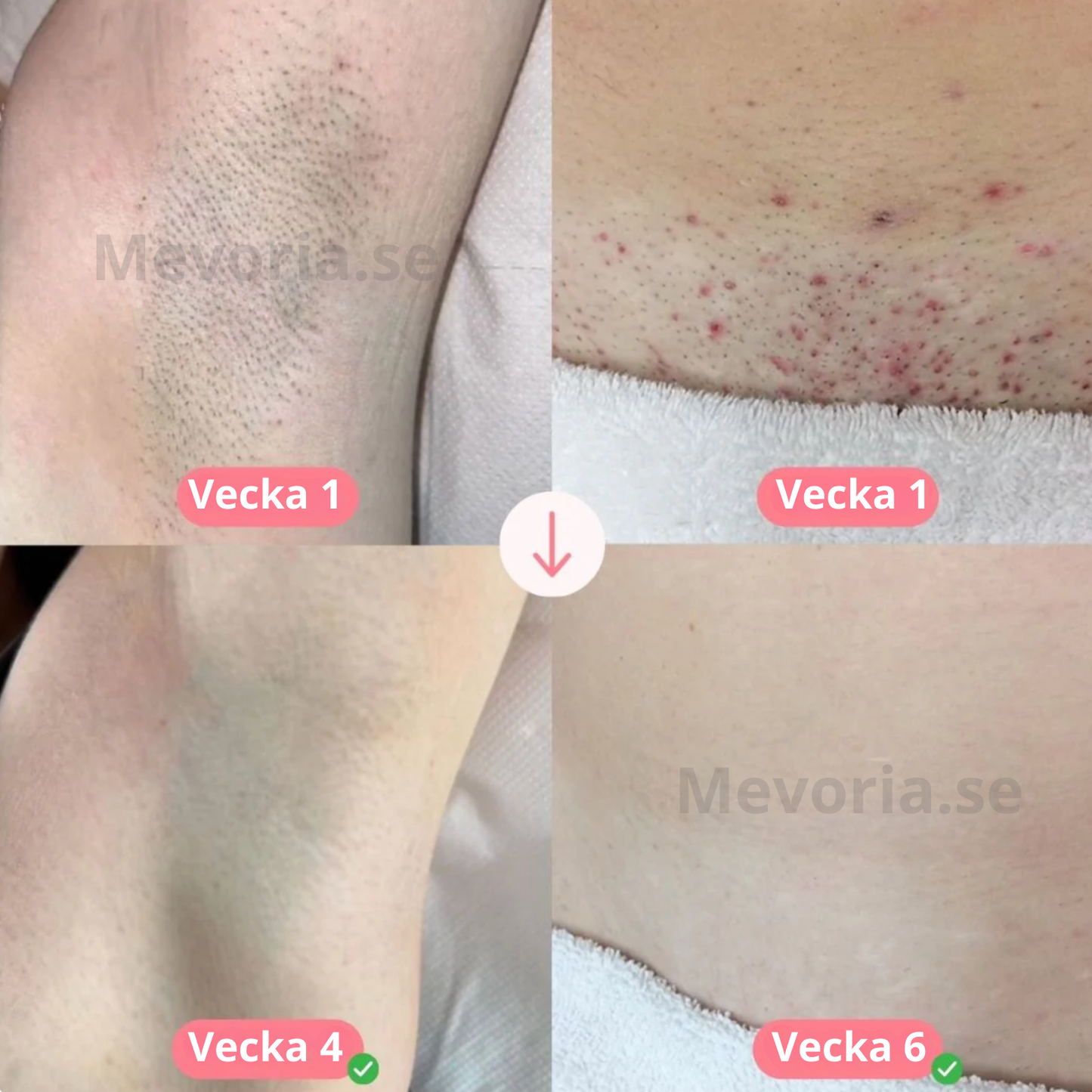 Mevoria IPL Pro® - Permanent Hårborttagare