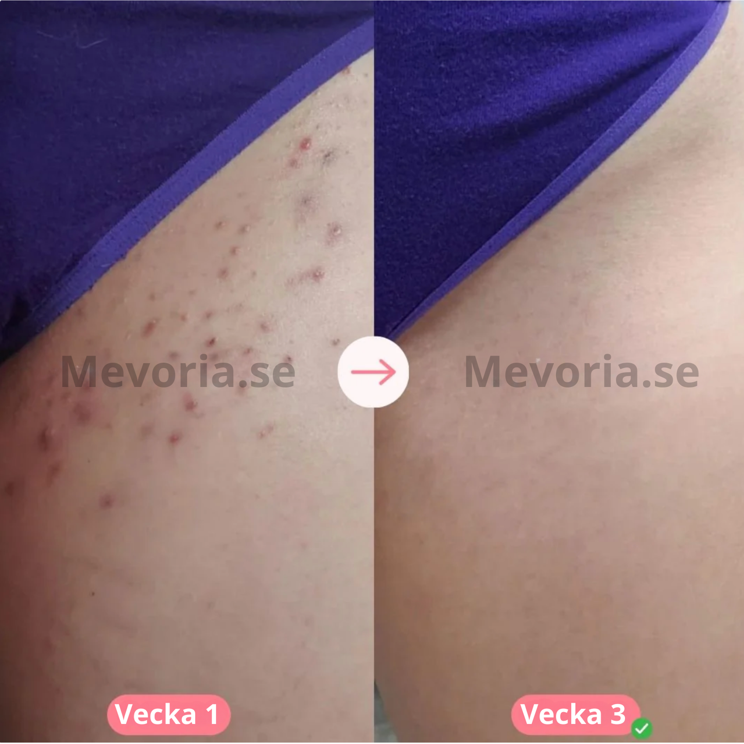Mevoria IPL Pro® - Permanent Hårborttagare