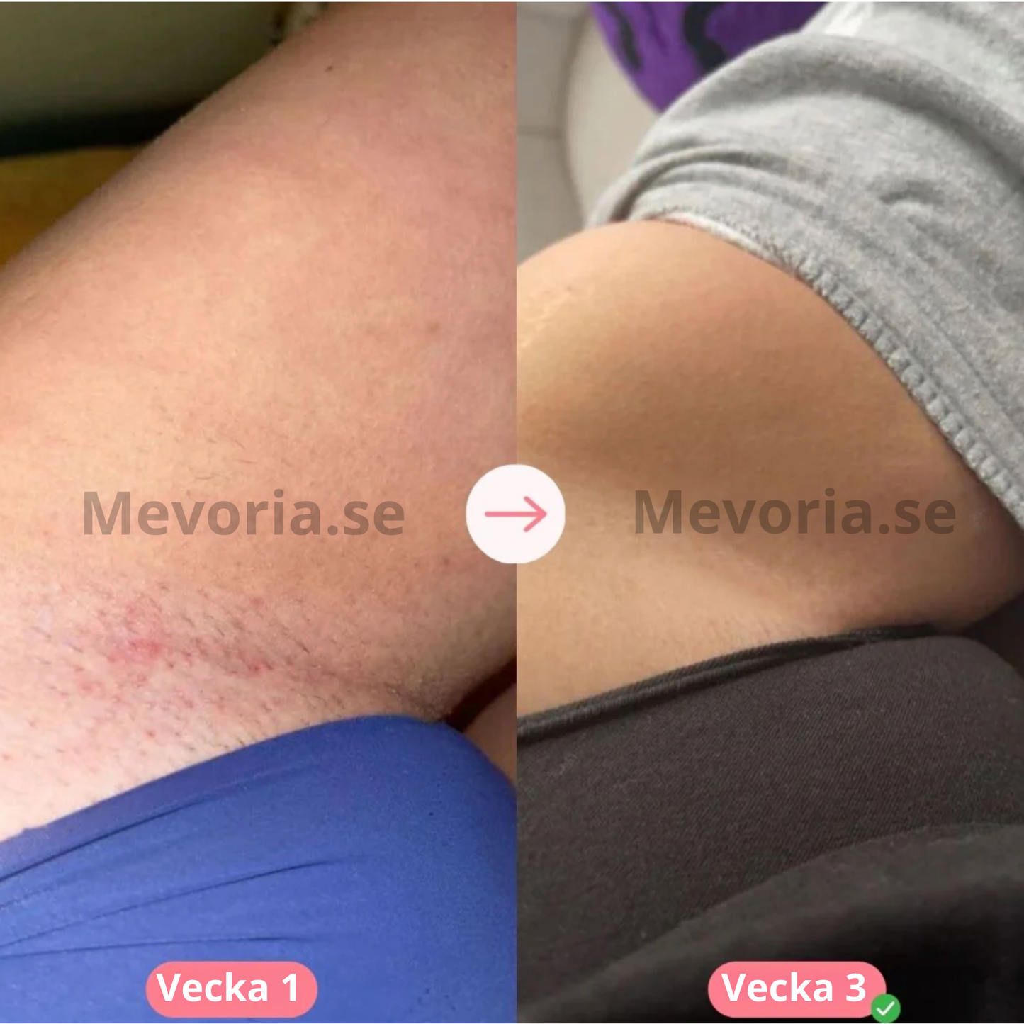 Mevoria IPL Pro® - Permanent Hårborttagare