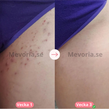 Mevoria IPL Pro® - Permanent Hårborttagare