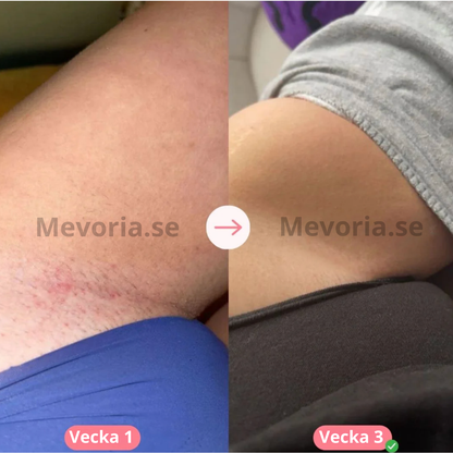 Mevoria IPL Pro® - Permanent Hårborttagare